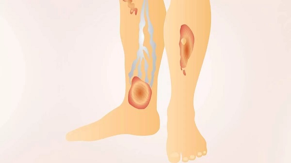 Язва трофическая на ноге: лечение